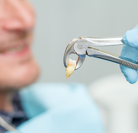 Tooth being extracted with dental forceps.